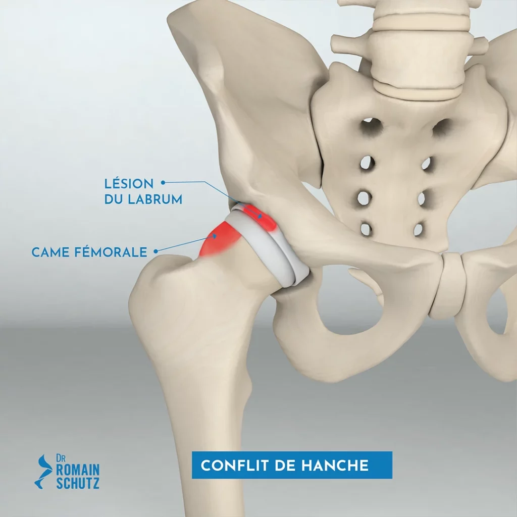 conflit-hanche