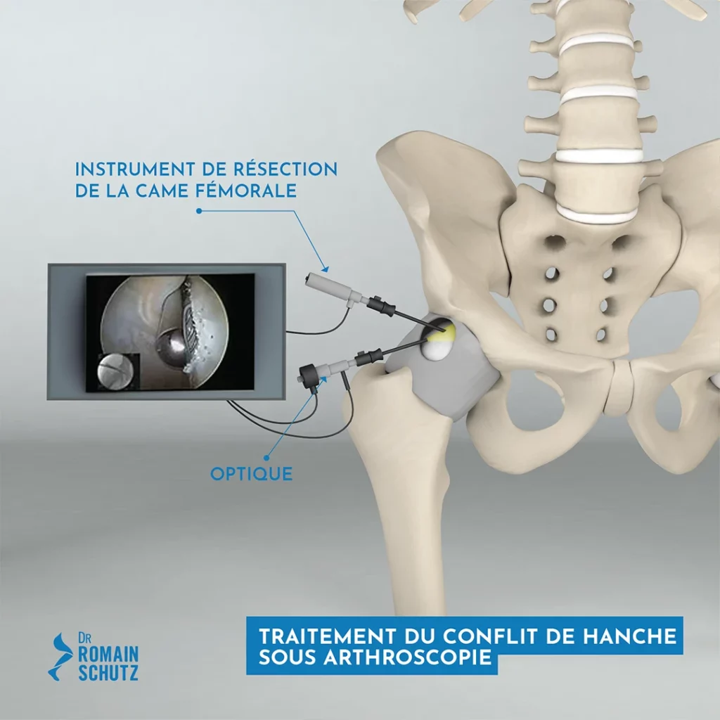 arthroscopie-hanche