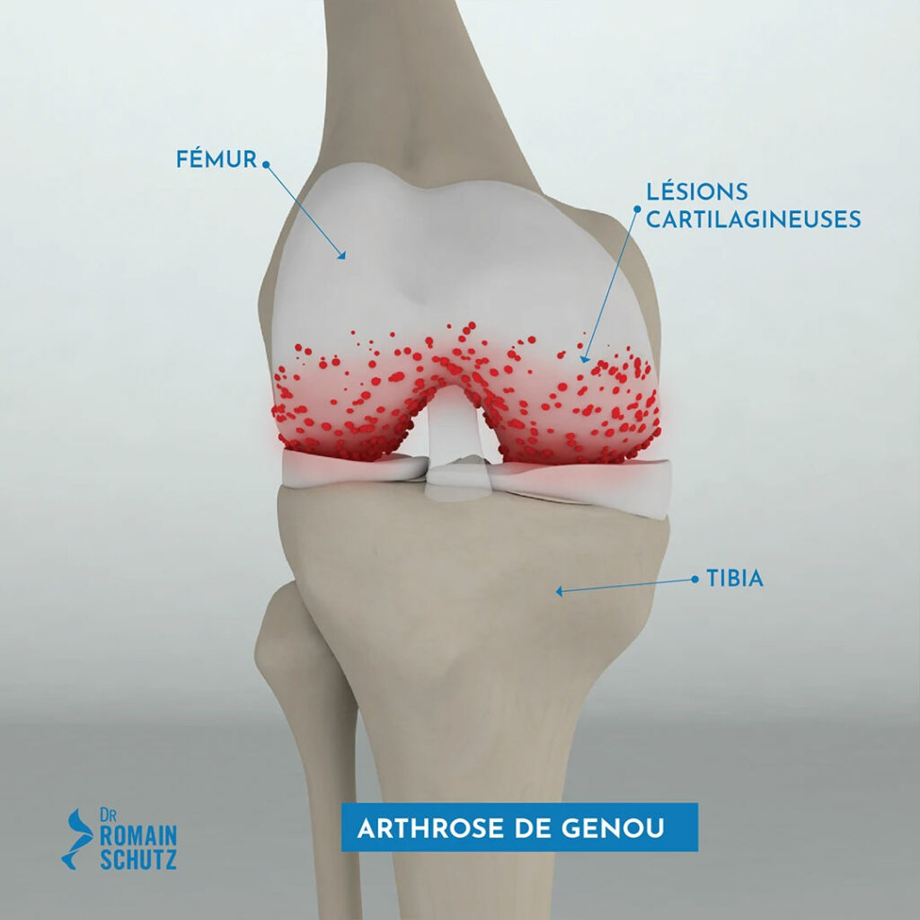 arthrose-genou
