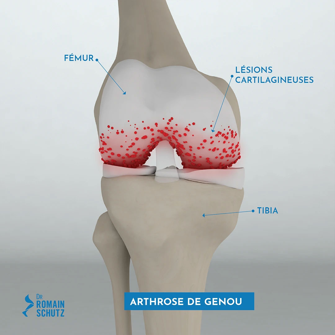 arthrose-genou