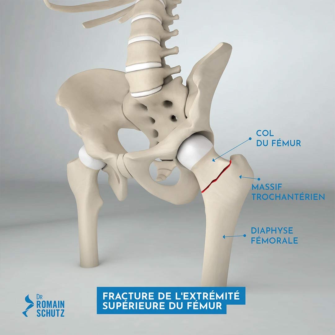 fracture-hanche-femur-1