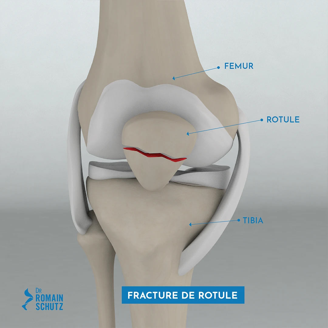 fracture-rotule-1