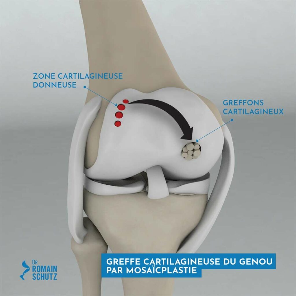 greffe-cartilage-genou-1