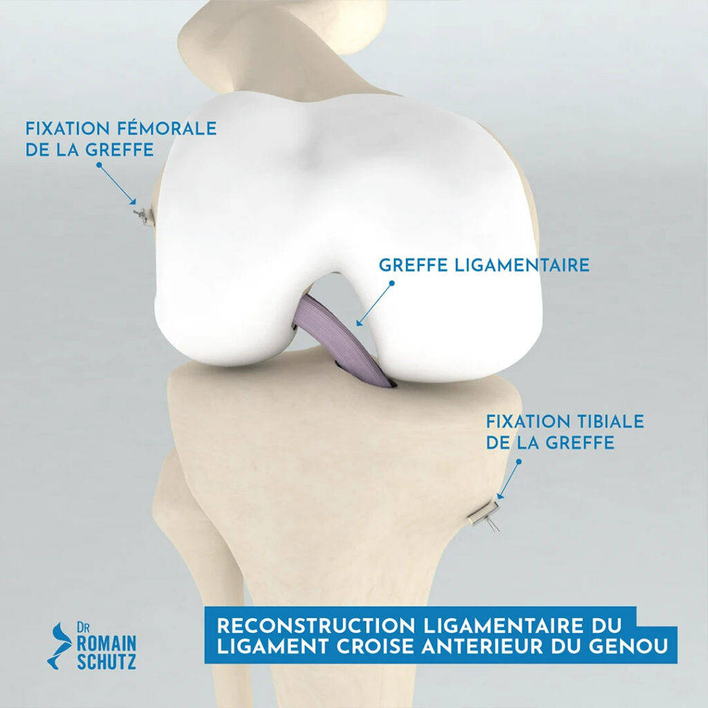 greffe-ligamentaire-genou-1