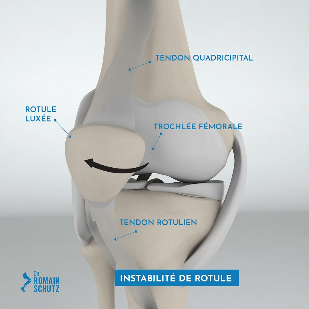 instabilite-rotule-genou