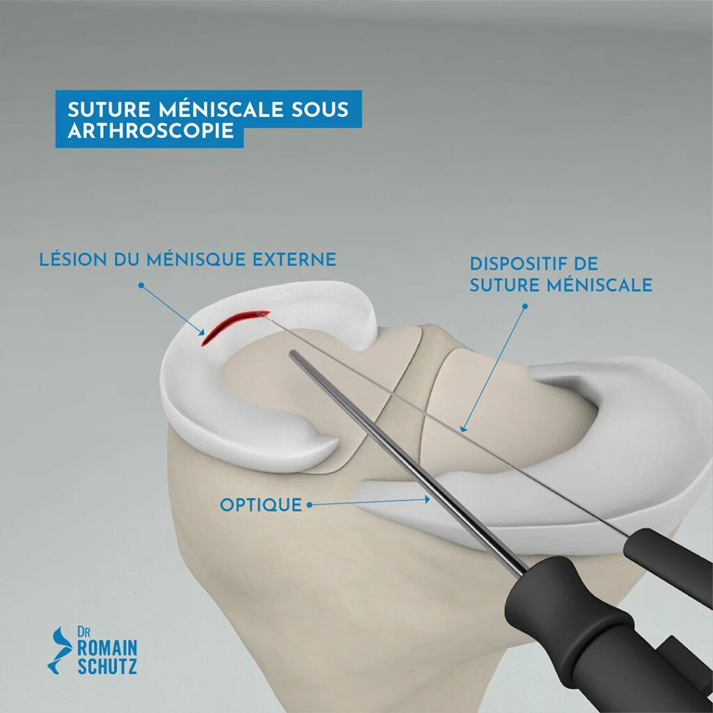 lesions-meniscales-genou
