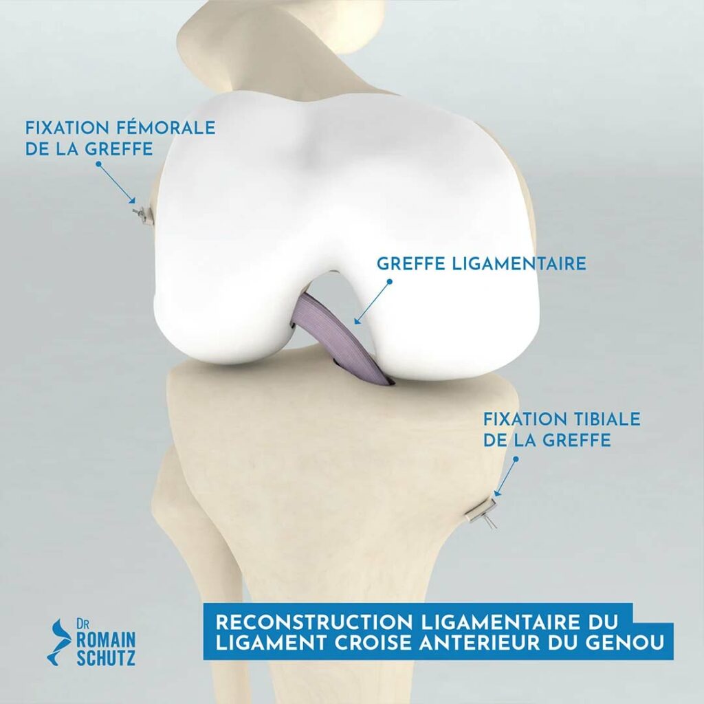ligamentoplastie-genou-1