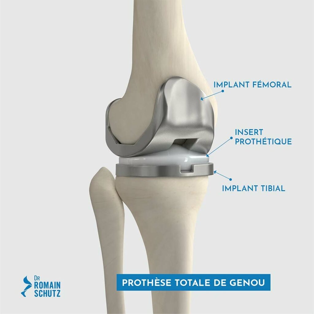 prothese-totale-genou-1