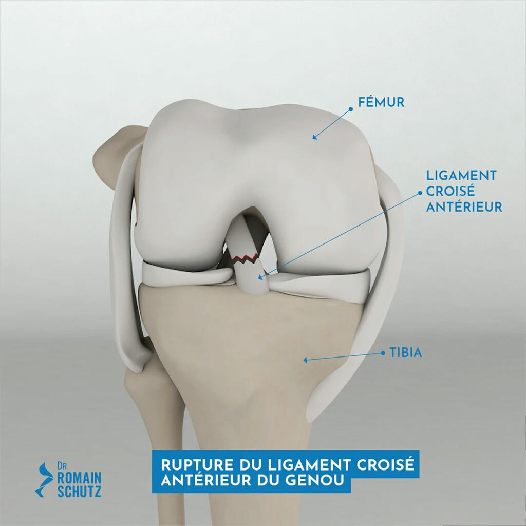 rupture-ligament-croise-genou
