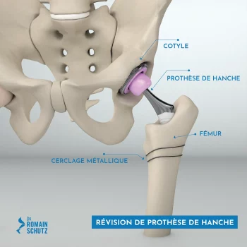 revision-prothese-hanche